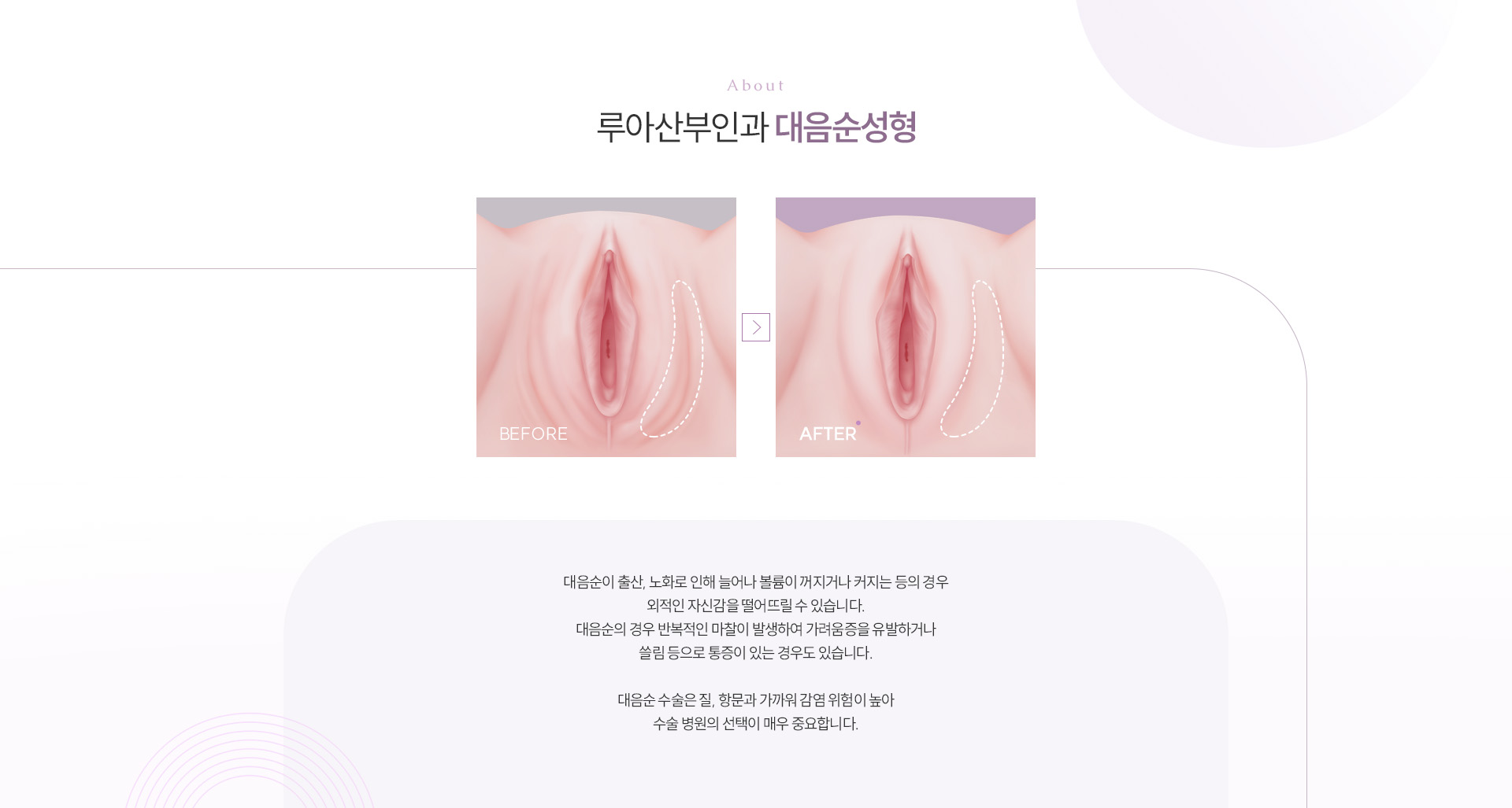 대음순성형 상세02