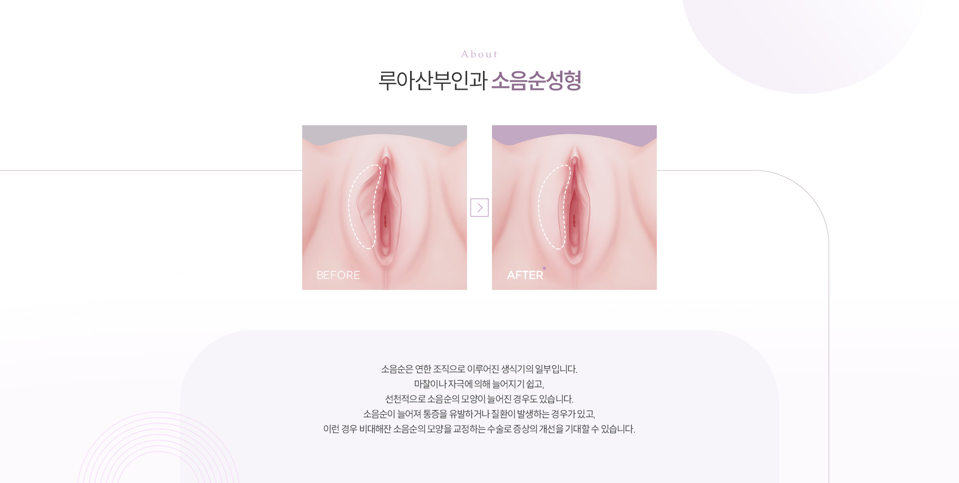 소음순성형 상세02